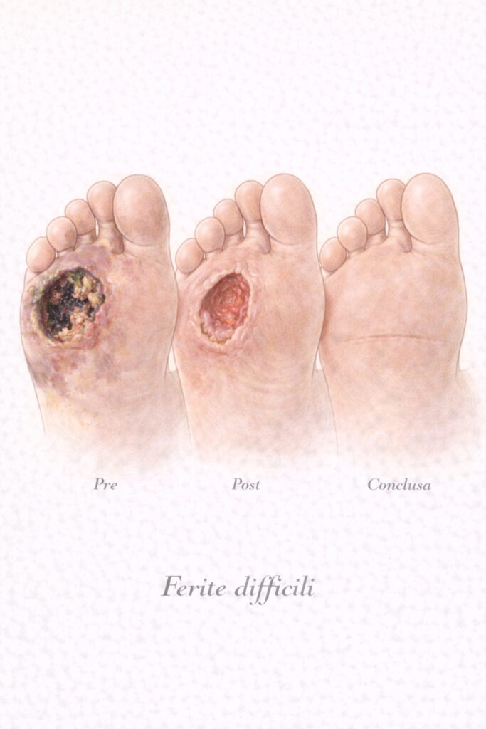 Ferite difficili e perdite di sostanza